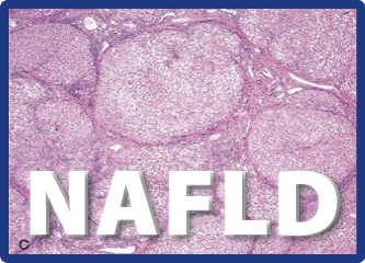 Overview And Management Of  Non Alcoholic Fatty Liver Disease (NAFLD) In Primary Care By Dr Harjinder Singh
